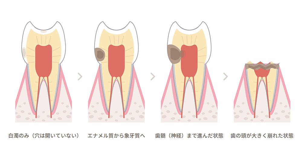 虫歯を放置すると、どのように進んでいくのか