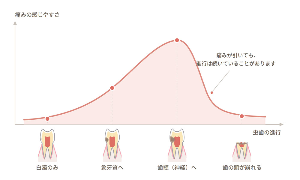 痛くない虫歯、痛みが消えた虫歯をどう考えるか