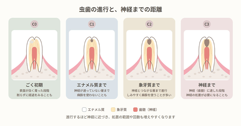 虫歯の進行と神経までの距離