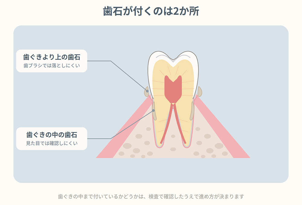 歯石が歯ぐきの中まで付いているとき